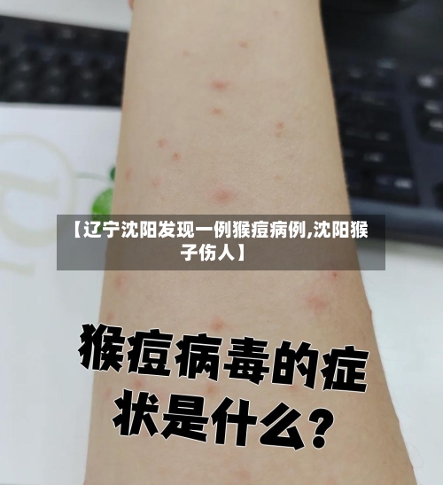 【辽宁沈阳发现一例猴痘病例,沈阳猴子伤人】-第1张图片